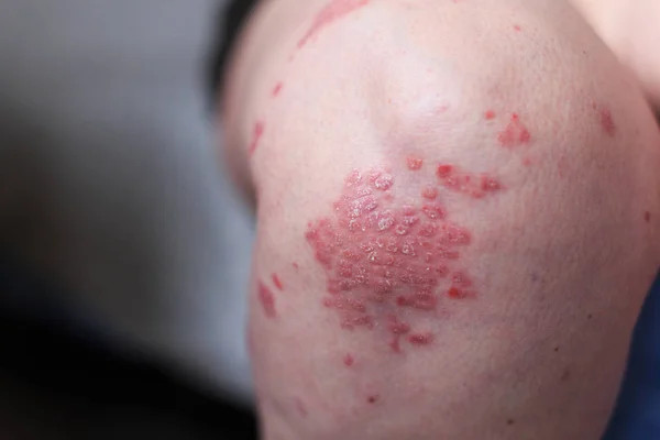 Psoriasis Vulgaris